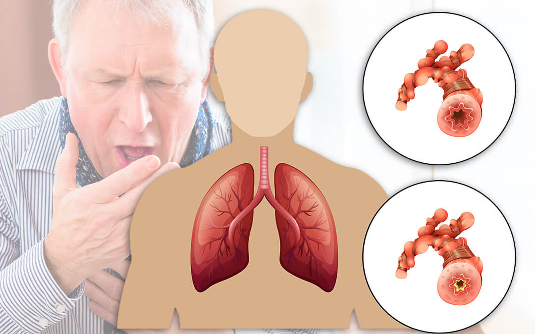 Navigating Life with COPD