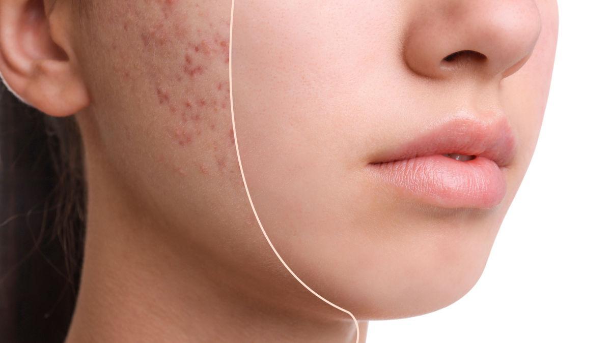 Gateway To Clear Skin: Face Wash for Acne-Prone Skin